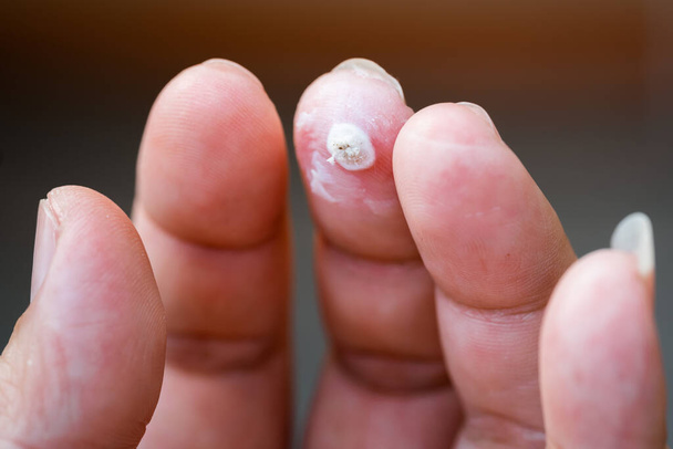White big warts on middle finger. - Photo, Image