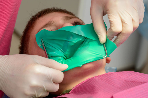 Стоматолог устанавливает резиновую плотину и зажим для лечения больного зуба, мальчик сидит в стоматологическом кресле. - Фото, изображение