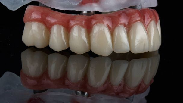 黒いガラスに反射して人工の歯茎を入れた歯科矯正の美しい角度 - 写真・画像