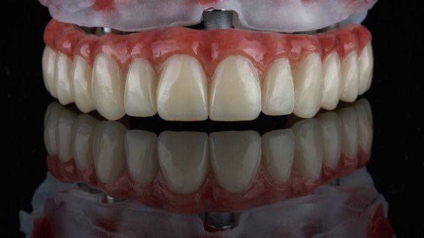 prótesis dental con goma de mascar artificial en la barra y el modelo, disparado en vidrio negro con reflexión - Foto, imagen