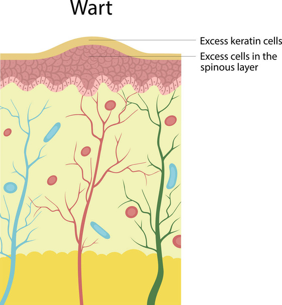 Excess keratin cells. Excess cells in the spinous layer - Vector, Image