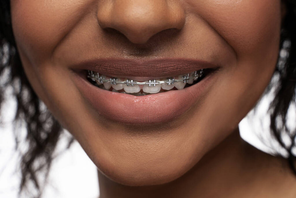 Orthodontics concept. Closeup of black woman's smile with a dental braces on teeth. - Photo, image