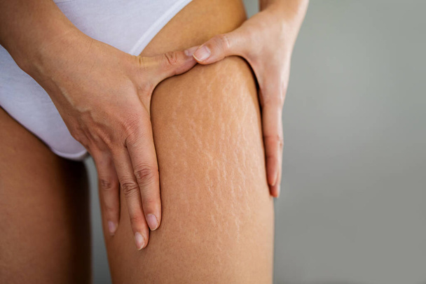 Dehnungsstreifen an weiblichen Beinen. Die Hand einer Frau hält eine fette Cellulite und ein Dehnungsstreifen am Bein. Cellulite. - Foto, Bild