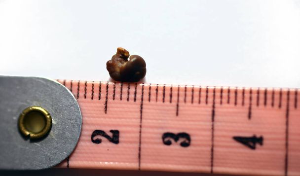 Nephrolithiasis, ein einzelner unregelmäßiger brauner Nierenstein (Nierenstein oder Nephrolith) auf weißem Hintergrund, Skala in Zentimetern, der Stein ist etwa 6 Millimeter groß, der im Urin weitergegeben wird - Foto, Bild