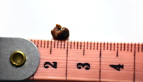 Nefrolitiasi, un singolo calcolo renale marrone irregolare (calcolo renale o nefrolito) su fondo bianco, scala in centimetri, il calcolo è di circa 6 millimetri di dimensione che ha urinato - Foto, immagini