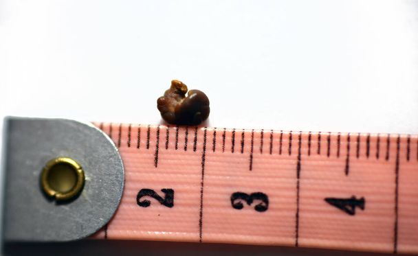kamica nerkowa, pojedynczy nieregularny brązowy kamień nerkowy (nerki lub nerki) na białym tle, skala w centymetrach, kamień jest około 6 milimetrów w rozmiarze, który przeszedł w moczu - Zdjęcie, obraz