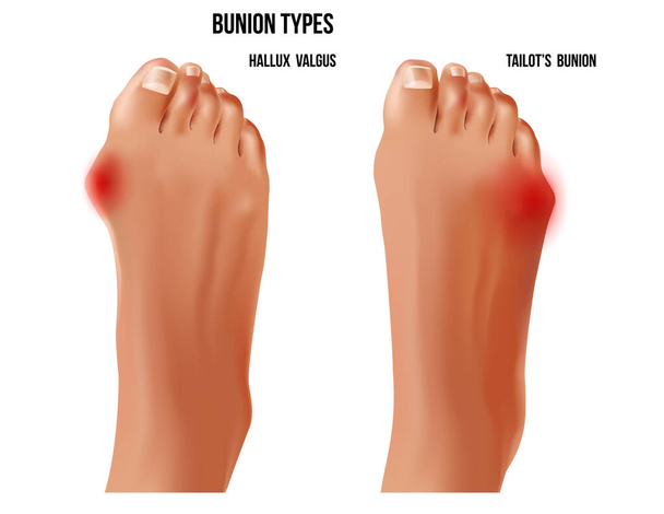 Artritic tailors bunion and hallux valgus foot bunion rheumatoid sore joints, top view. - Vector, Image