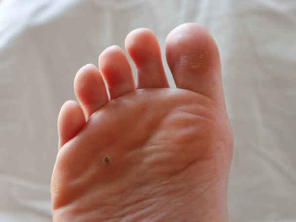 Primo piano di una verruca estesa su un piede adulto - Foto, immagini