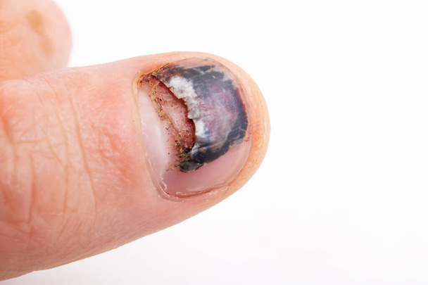 De nagel schilfert af op de vinger en de blauwe plek - Foto, afbeelding