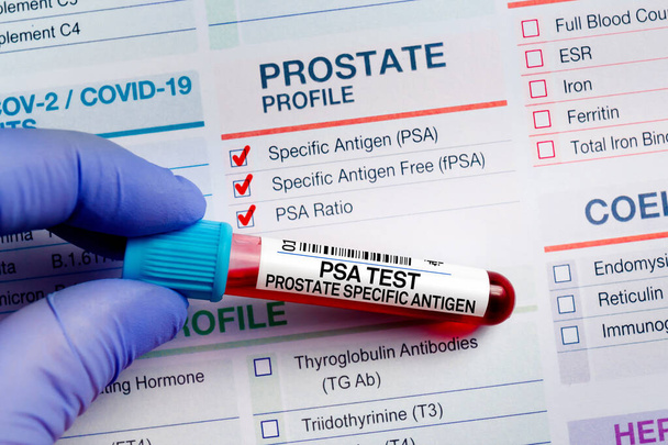Tubo del campione di sangue per l'analisi del test del profilo dell'antigene specifico della prostata PSA in laboratorio. Test del tubo sanguigno con modulo di richiesta per PSA Prostata Test antigene specifico - Foto, immagini
