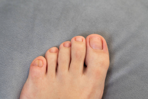 Pieds féminins avec gros double petit orteil sur fond gris - Photo, image
