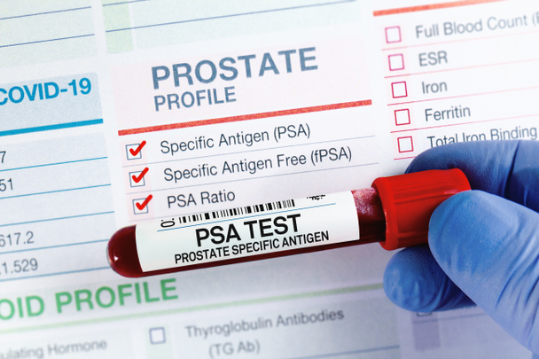 Badanie krwi z formularzem zapotrzebowania na badanie swoistego antygenu prostaty PSA. Próbka krwi do analizy swoistego profilu antygenu gruczołu krokowego PSA w laboratorium - Zdjęcie, obraz