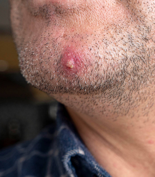 acné inflamado en la piel facial de una persona, acné grande solo en la cara, - Foto, imagen