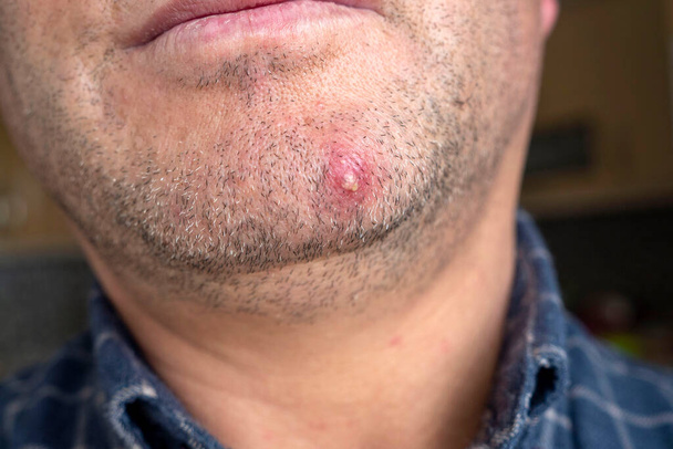 acné inflamado en la piel facial de una persona, acné grande solo en la cara, - Foto, imagen