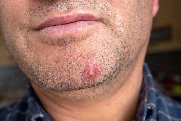 acné inflamado en la piel facial de una persona, acné grande solo en la cara, - Foto, Imagen