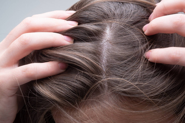Close up of woman examining her scalp and hair, hair loss on hairline or dry scalp problem. - Foto, imagen