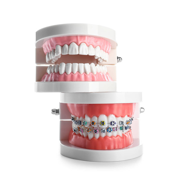 Beyaz arkaplanda izole edilmiş diş telleri ile çene modeli - Fotoğraf, Görsel