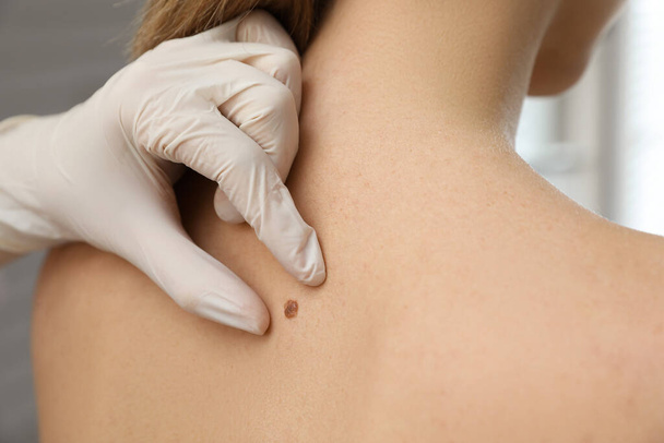 Dermatologist examining patient's birthmark in clinic, closeup view - Foto, Imagen