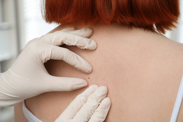 Dermatologist examining patient's birthmark in clinic, closeup view - Photo, Image