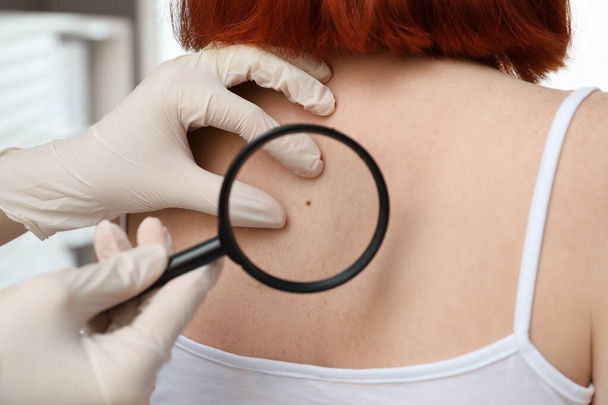 Dermatologist examining patient's birthmark with magnifying glass in clinic, closeup view - Foto, Imagen
