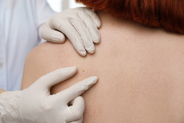 Dermatologist examining patient's birthmark in clinic, closeup view - Foto, Bild