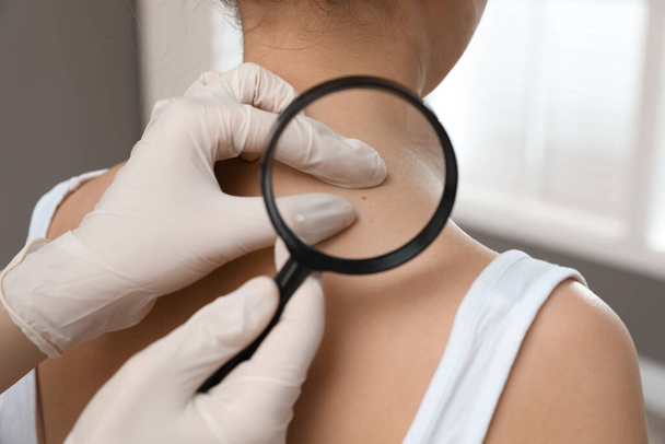 Dermatologist examining patient's birthmark with magnifying glass in clinic, closeup view - Fotó, kép