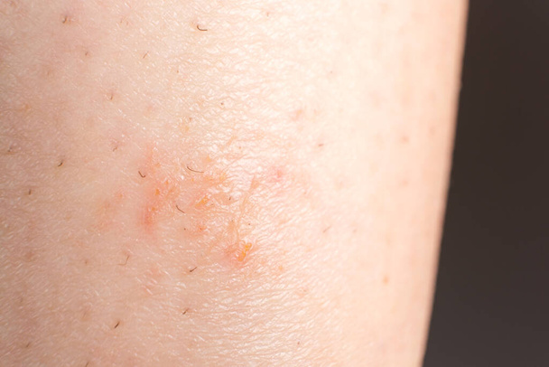 Streptoderma - dermatitis on human skin, red round spot, macro photography, bacterial inflammation - Photo, Image