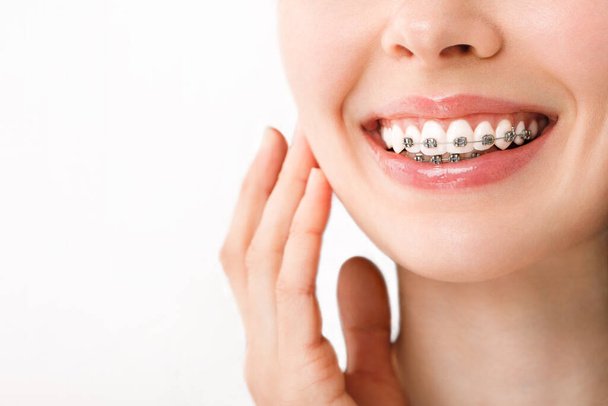 Sourire avec orthèses traitement orthodontique. Concept de soins dentaires. Belle femme sourire sain de près. Supports en céramique et en métal sur les dents. Belle femelle - Photo, image