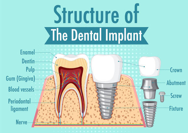 Infografika człowieka w strukturze implantu dentystycznego ilustracja - Wektor, obraz