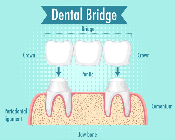 Інфографіка людини в ілюстрації стоматологічного мосту
 - Вектор, зображення