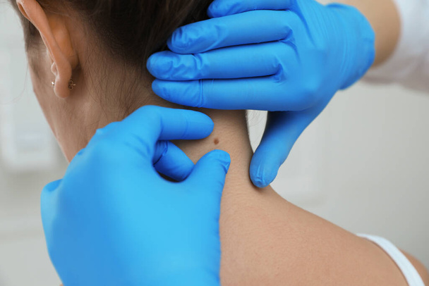 Dermatologist examining patient's birthmark in clinic, closeup view - 写真・画像