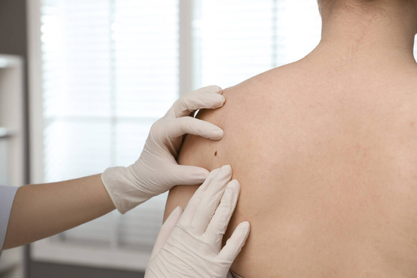 Dermatologist examining patient's birthmark in clinic, closeup view - Foto, afbeelding