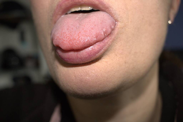 geschwollene, vergrößerte, weiße Zunge mit welligen, wellenförmigen überbuchten Rändern (medizinischer Name ist Makroglossie) und Unebenheiten - Foto, Bild