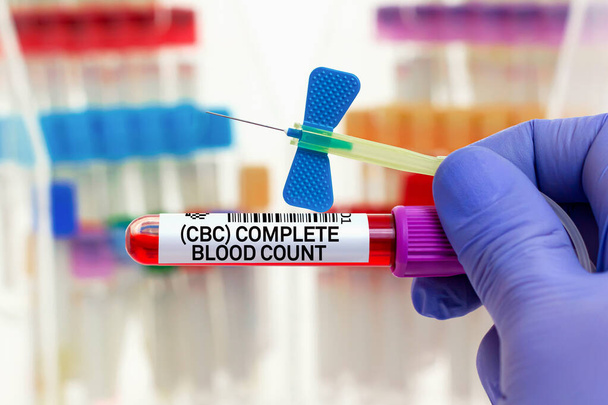 Δείγμα αίματος ασθενούς για γενική εξέταση αίματος CBC FBC στο εργαστήριο. γιατρός με σωλήνα αίματος και βελόνα για γενική CBC Πλήρης εξέταση αίματος στο εργαστήριο - Φωτογραφία, εικόνα