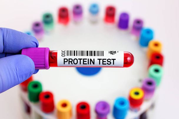 Échantillon sanguin du patient pour un test protéique en laboratoire. Médecin avec tube sanguin pour test protéique en laboratoire - Photo, image