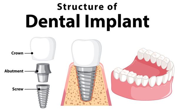 Infográfico da estrutura humana da ilustração do implante dentário - Vetor, Imagem