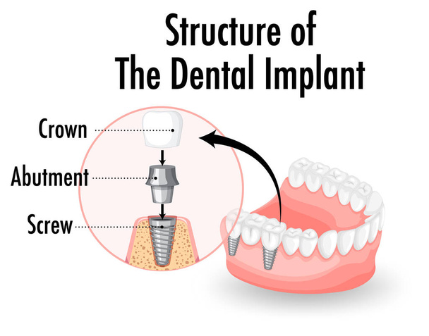 Infografika człowieka w strukturze implantu dentystycznego ilustracja - Wektor, obraz