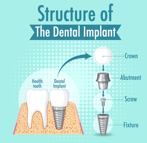 Informace o lidské struktuře zubního implantátu ilustrace - Vektor, obrázek