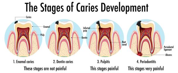 Infographic of human in the stage of caries development illustration - Vektor, obrázek