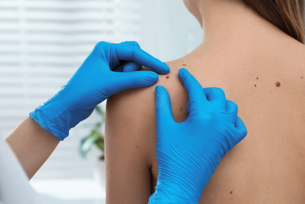 Dermatologist examining patient's birthmark in clinic, closeup view - Фото, зображення