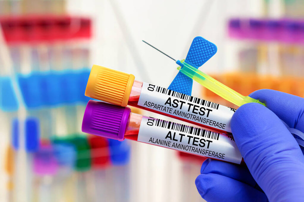 Vzorky krve pacienta pro AST a ALT test v laboratoři. lékař s krevními zkumavkami a jehlou pro AST aspartátaminotransferázu a ALT alaninaminotransferázový test v laboratoři - Fotografie, Obrázek