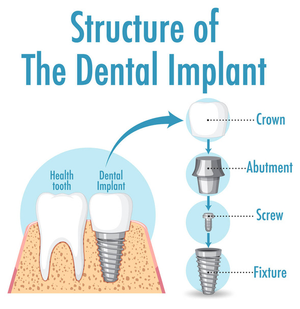 Infográfico da estrutura humana da ilustração do implante dentário - Vetor, Imagem