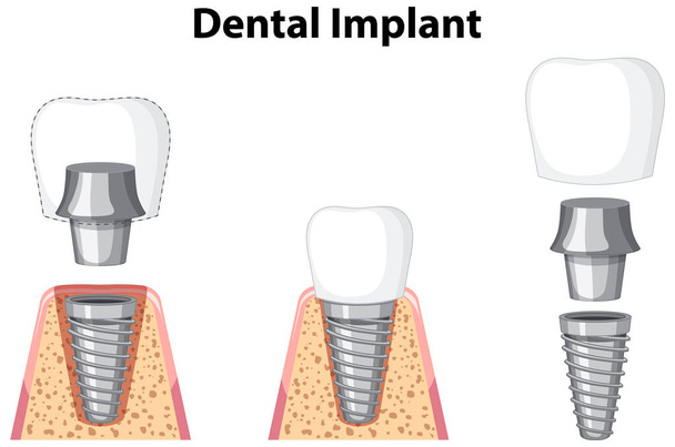 Dental implant in gum on white background illustration - Vector, Image