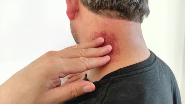 redness after neck stiffness, redness on the neck, a man's neck is red and bruised, - Footage, Video