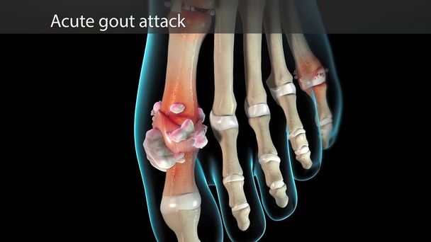 Gota é uma forma de artrite. Ataques súbitos e intensos de dor, inchaço - Foto, Imagem