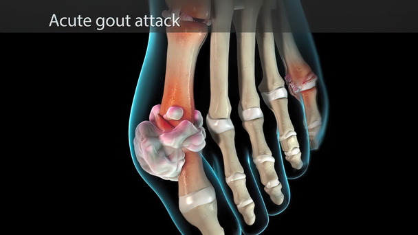 Jicht is een vorm van artritis. Plotselinge, ernstige pijnaanvallen, zwelling - Foto, afbeelding