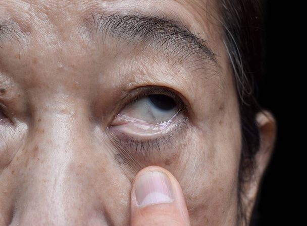 Бледная кожа азиатской пожилой женщины. Признак анемии. Бледность глаз. - Фото, изображение