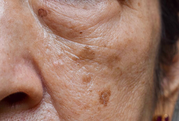 Kleine bruine vlekken genoemd ouderdomsvlekken op het gezicht van Aziatische oudere vrouw. Ze worden ook wel levervlekken, seniele linzen of zonnevlekken genoemd. Close-upzicht. - Foto, afbeelding