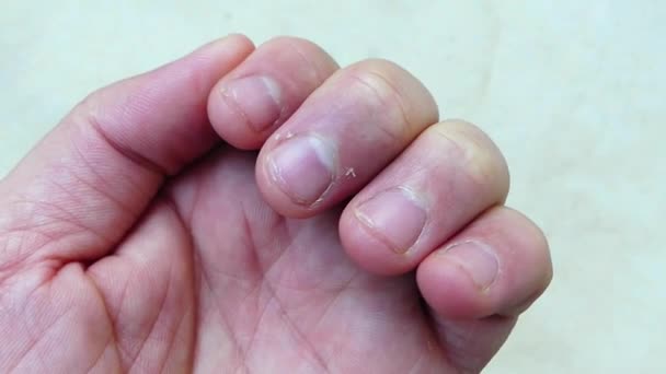 пилинг кожи на ногтях пальцев, дефицит витамина С и заболевания кожи ногтя, - Кадры, видео