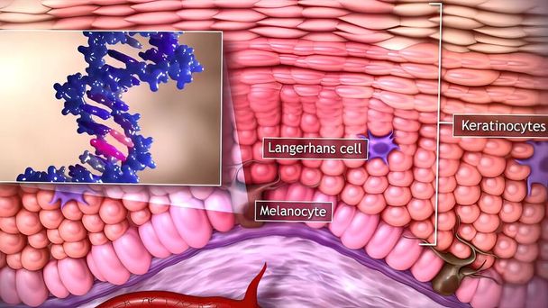 3D ιατρική απεικόνιση του καρκίνου του δέρματος: Καρκίνωμα πλακωδών κυττάρων, βασικοκυτταρικό καρκίνο - Φωτογραφία, εικόνα